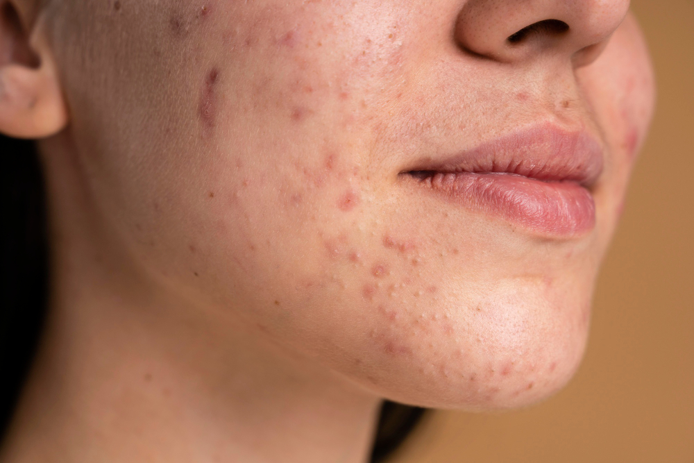 cicatrices acne Pamplona
