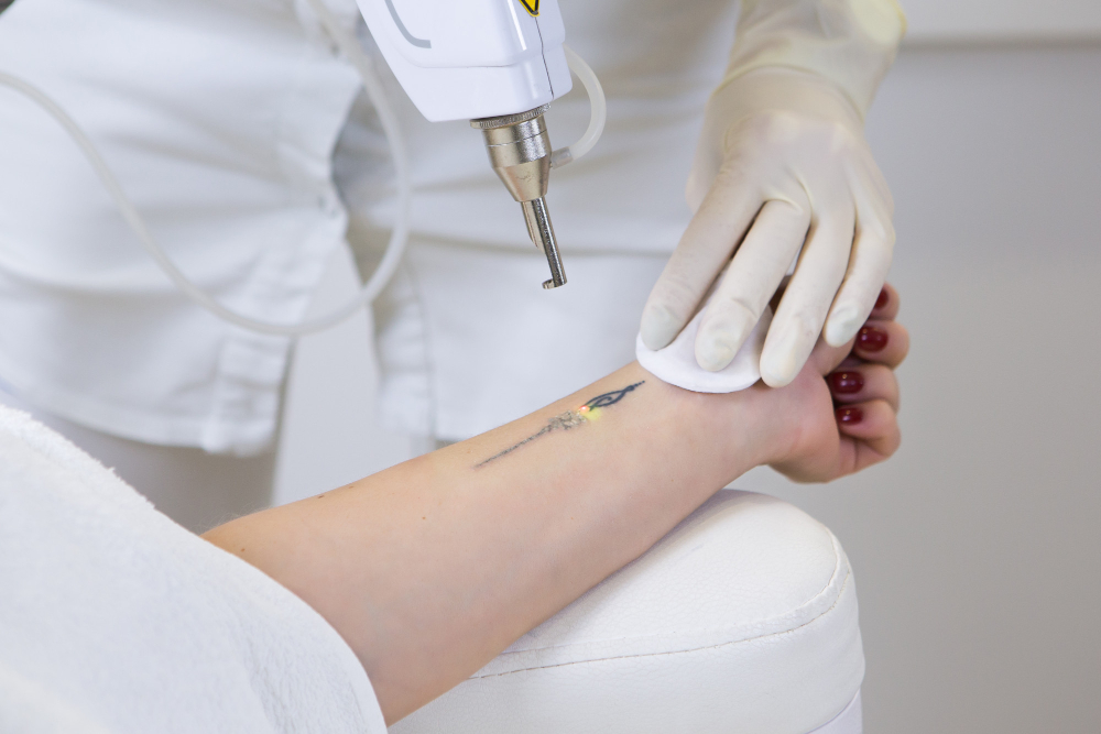 eliminar tatuaje Pamplona